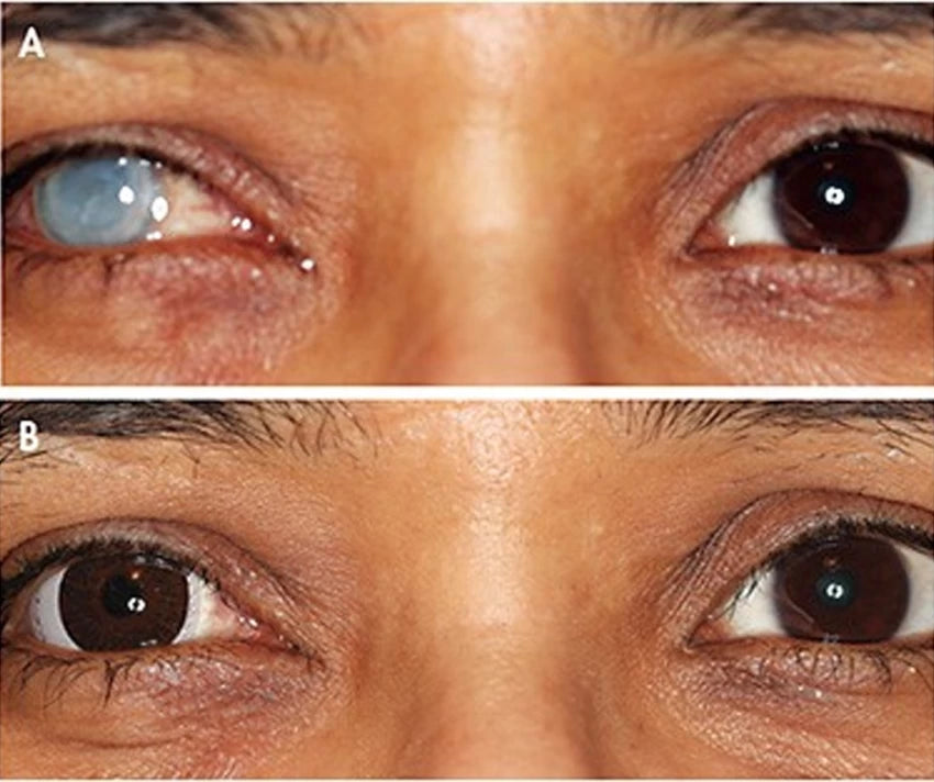 Silklens Prosthetic D-Type Center Pupil Black Contact Lens (1 Lens)