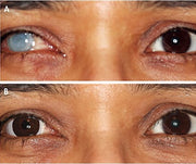 Silklens Prosthetic D-Type Center Pupil Black Contact Lens  (1 Lens)